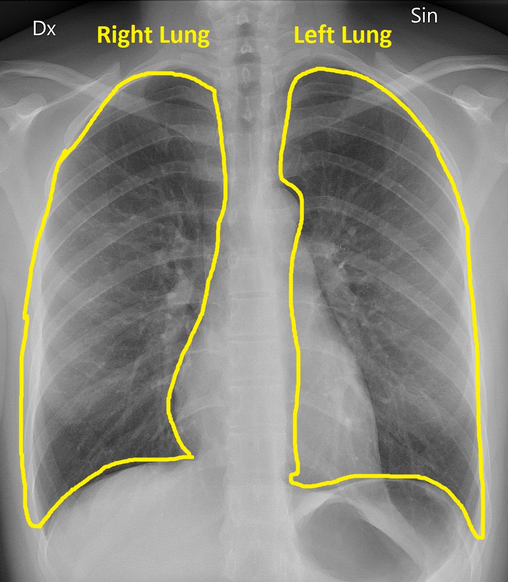 Normal_CXR-lungs