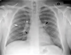 Chest_X-ray_of_discrete_round_nodules_after_secondary_tuberculosis