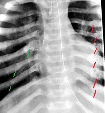 Multiple_Rib_Fractures