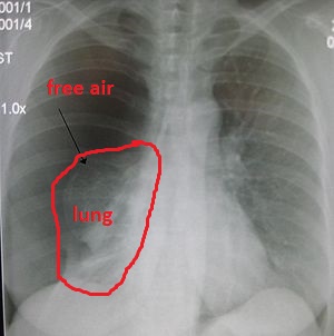 pnumothorax- outlined