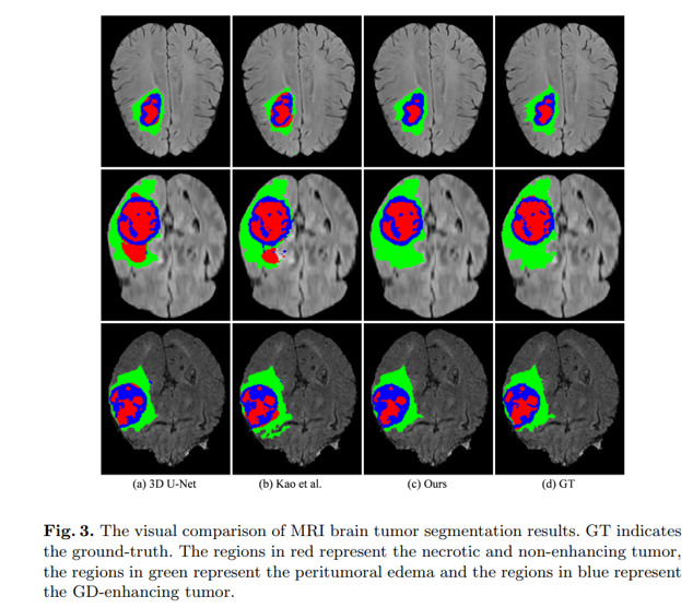 brain-tumors-mri