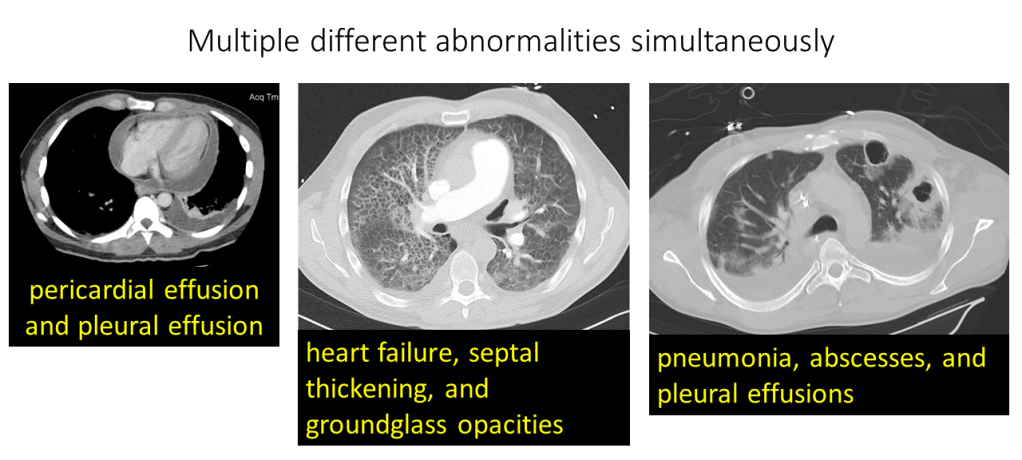 Automatic Interpretation of Chest CT Scans with Machine Learning ...