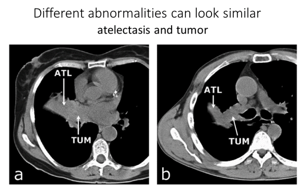 Automatic Interpretation of Chest CT Scans with Machine Learning ...