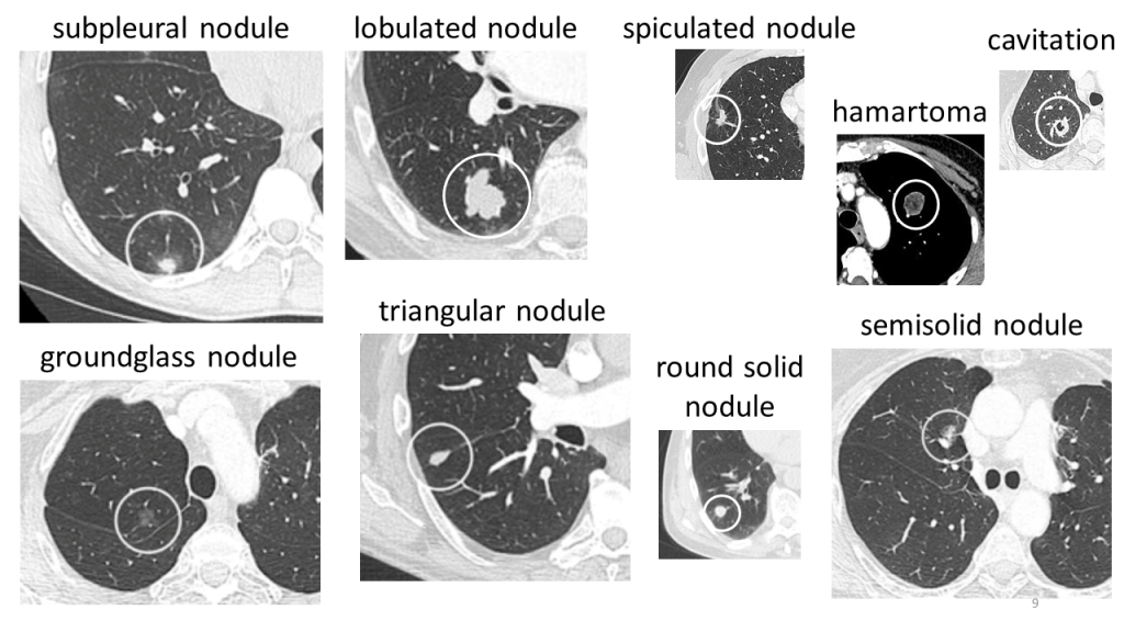Automatic Interpretation of Chest CT Scans with Machine Learning ...