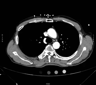 Automatic Interpretation of Chest CT Scans with Machine Learning ...