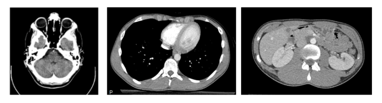 Python Ct Scan Cross Section Downloading and Preprocessing Medical Images in Bulk: DICOM to NumPy ...